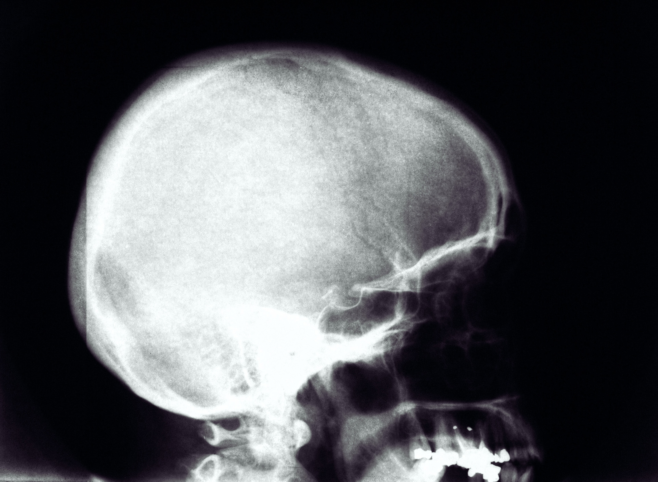 Radiografia cranio e seni paranasali